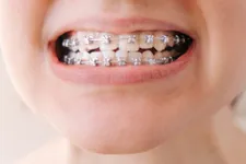 Best & Worst Foods To Eat With Braces